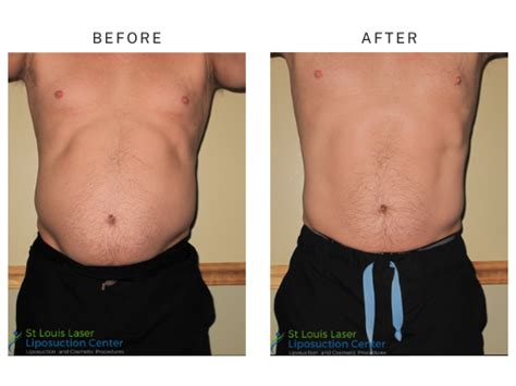 Liposuction in St. Louis, MO 